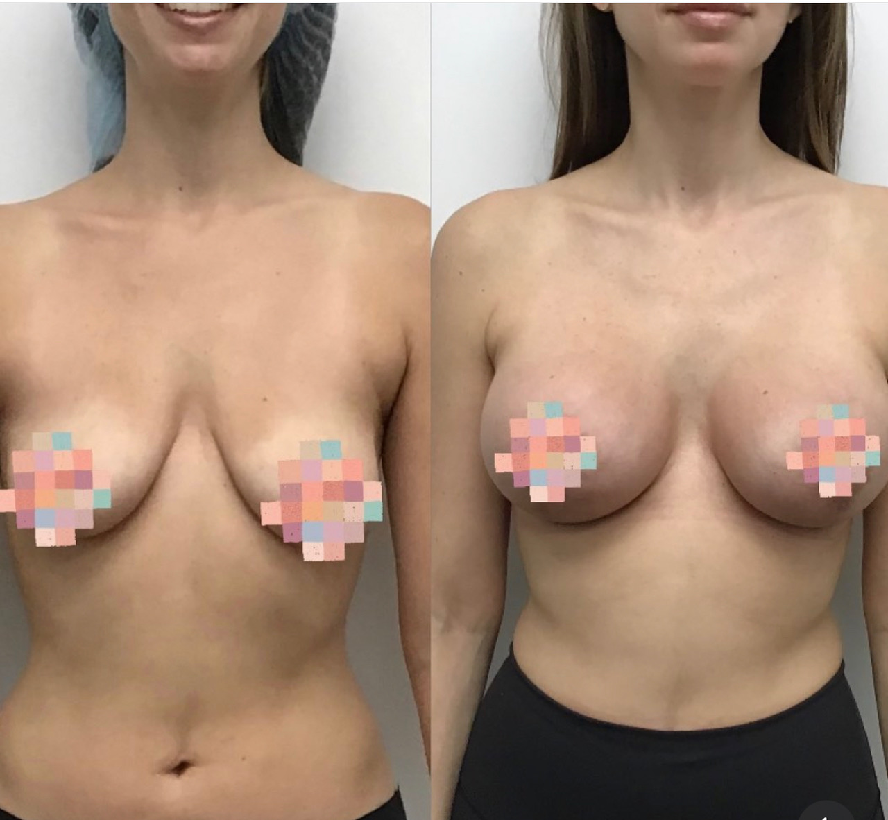 Before and after breast augmentation showing enhanced size and shape. Before and after breast augmentation showing enhanced size and shape.