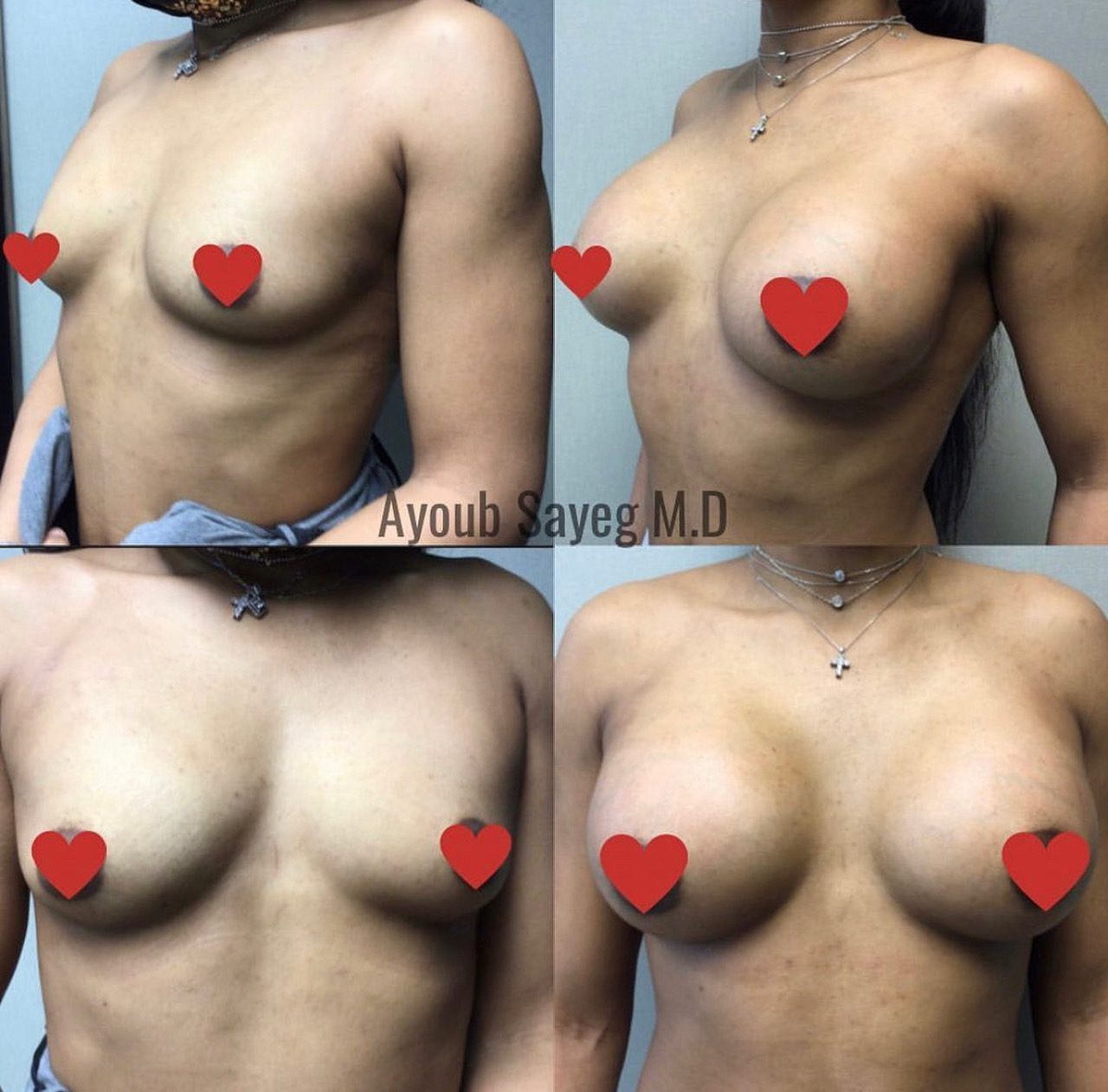 Before and after breast augmentation showing natural enhancement. Before and after breast augmentation showing natural enhancement.