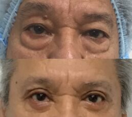 Before and after eye bag removal surgery showing significant improvement.