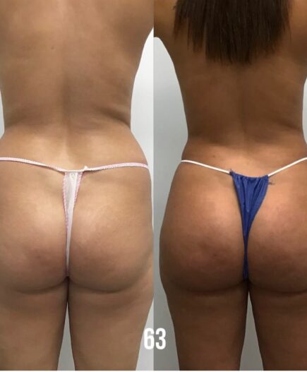 BBL before and after picture from 63 Laser & Skin Clinic