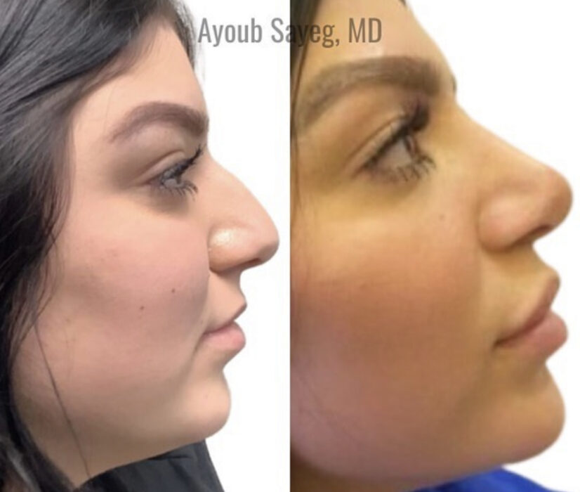 Rhinoplasty - 63 Laser & Skin Clinic is the Most Affordable Plastic ...