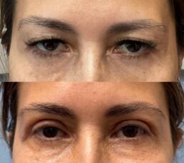 Before and after eyebrow enhancement treatment on a woman's face.