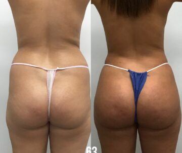 Brazilian Butt Lift - Before & After
