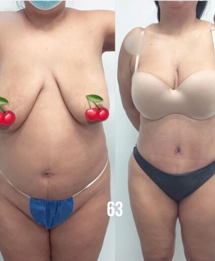 Tummy Tuck before and after at 63 Laser & Skin Clinic.